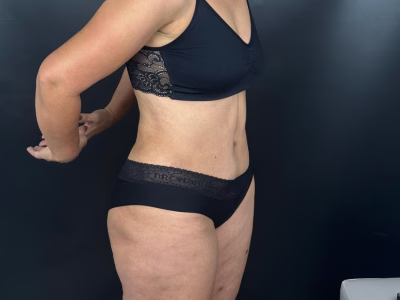 Abdominoplastia post-bariátrica ALMO Clinic