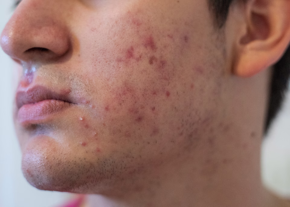 Tratamiento de acné con láser en ALMO Clinic