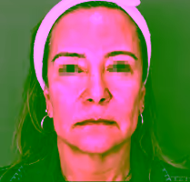 Before blepharoplasty in Bogotá - Eyelid excess skin and bags
