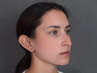 Antes del Rinoplastia ultrasónica