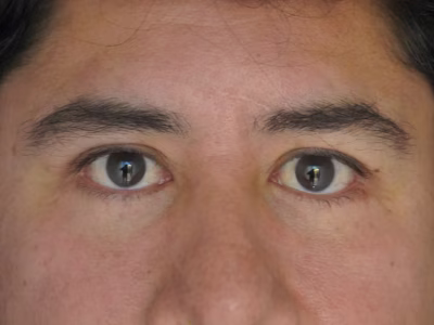 Blefaroplastia en ALMO Clinic Bogotá