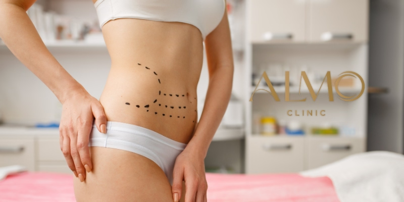 Why abdominoplasty wounds open: 6 preventable causes