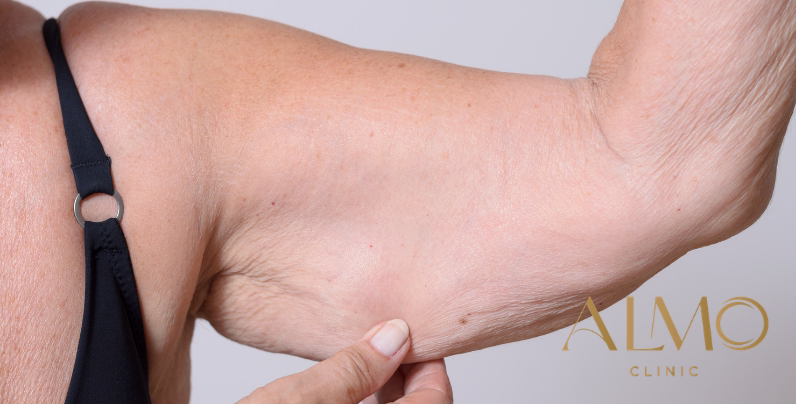 BodyTite vs Brachioplasty for arms