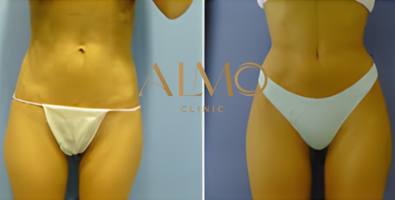 Reducción de perímetro por zona: abdomen 6-12cm, brazos 3-5cm, muslos 4-8cm Resultados por zona corporal: abdomen, brazos y muslos