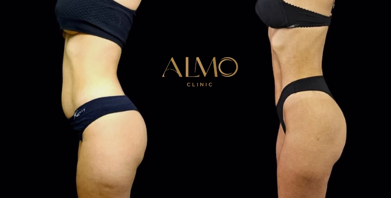 Elasticidad cutánea, IMC 25-32 y cumplimiento post-op son clave para resultados excelentes Factores que influyen en los resultados de BodyTite