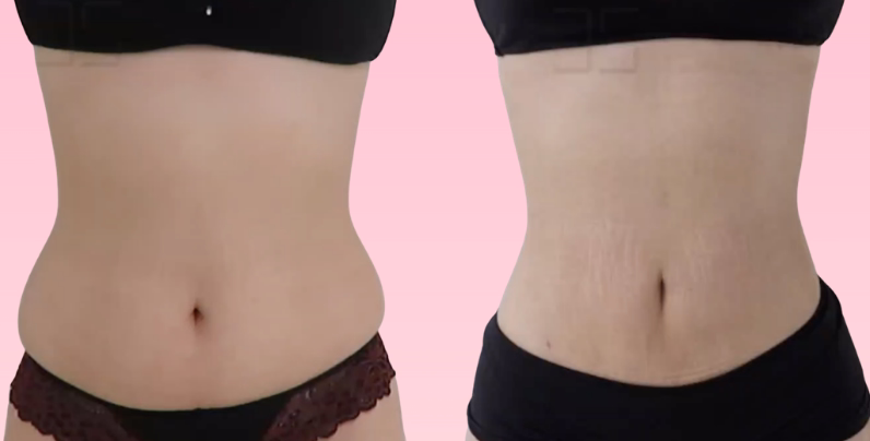 Timeline de resultados: mes 3 = 80% resultado final, mes 6 = 100% tensión cutánea Evolución temporal de resultados BodyTite