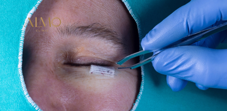 Herniated fat bags under the eyes — indication for lower blepharoplasty in Bogotá ALMO Clinic