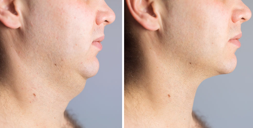 ¿Por qué se forma la papada? Causas y factores de riesgo | ALMO Clinic