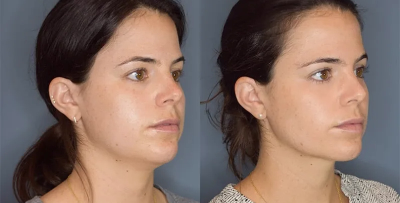 Causes of double chin: genetics and risk factors Bogotá Causes of double chin: genetics and risk factors Bogotá