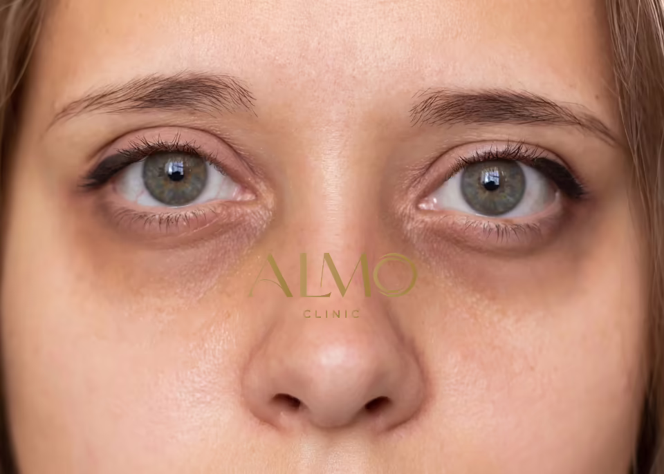 Types of dark circles: pigmented, vascular and hollow Close-up of dark circles under both eyes, with darker skin on the lower eyelids