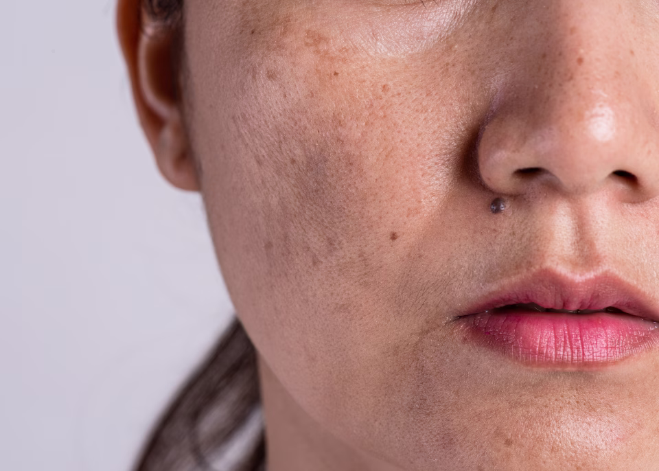 Phases of medical melasma treatment: attack, consolidation and maintenance Infographic of the long-term melasma treatment workflow: attack phase, consolidation, and prevention