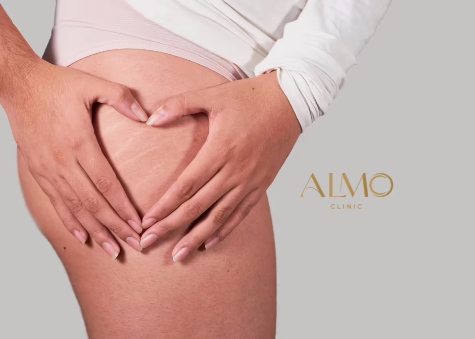 Estrías en muslos y piernas: dónde aparecen Mujer formando un corazón con las manos sobre el muslo, donde se ven estrías finas