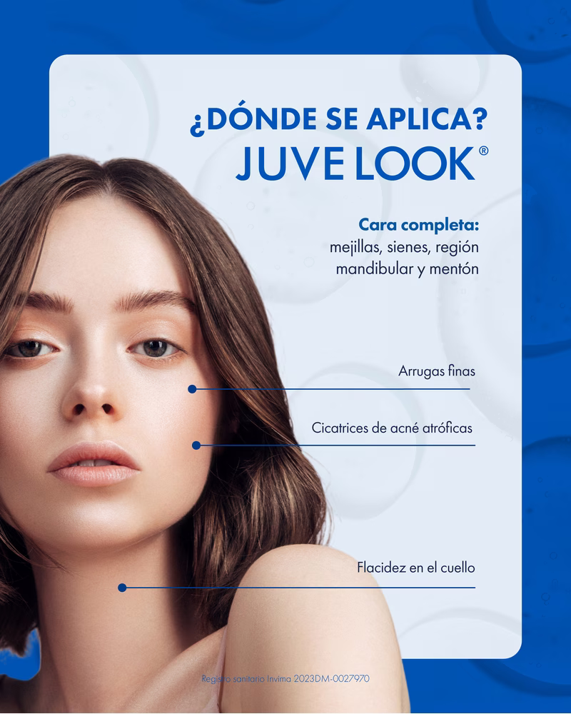 Juvelook where it is applied — facial zones including atrophic acne scars Colombia