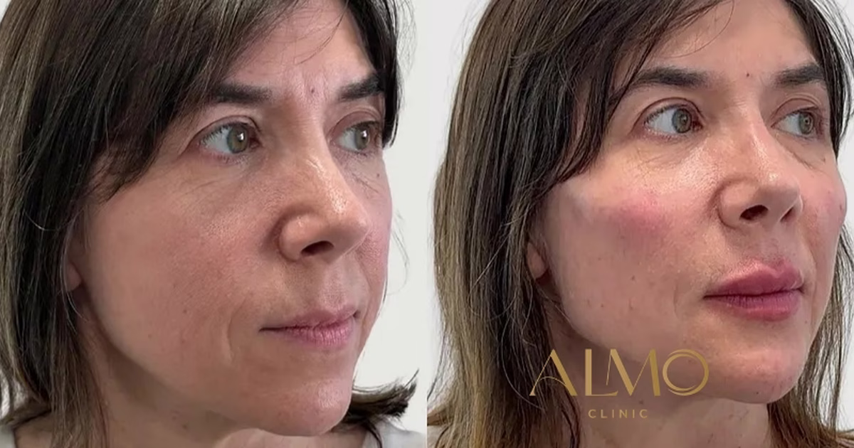 Juvelook vs Sculptra: Which Bio-Stimulator to Choose in Colombia?