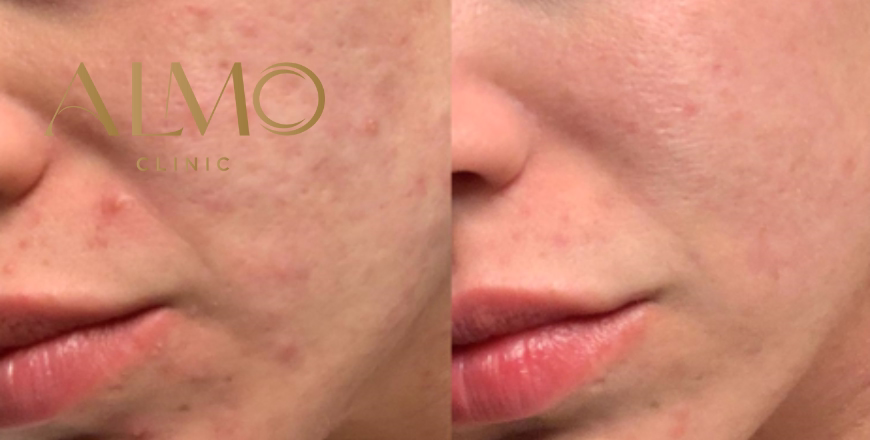 CO2 Laser vs Morpheus8 for acne scars: complete comparison