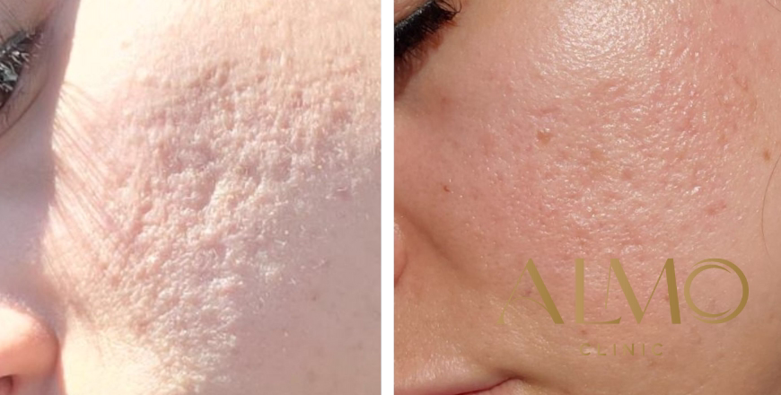 CO2 Laser vs Morpheus8: Which One Better Eliminates Acne Scars? [2025]