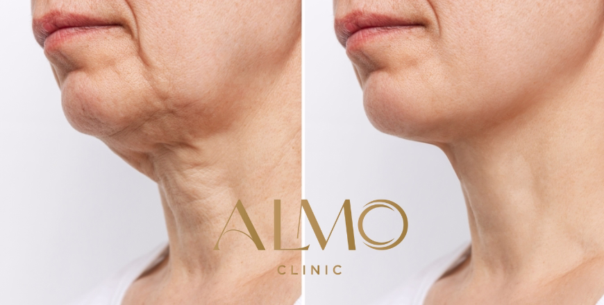 Liftera Results Bogotá: Real Testimonials and Photographic Evidence