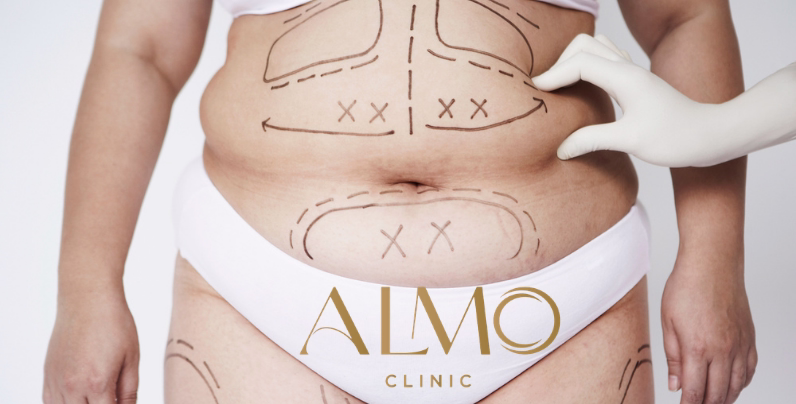 Lipólisis láser con fibra vs liposucción con cánula