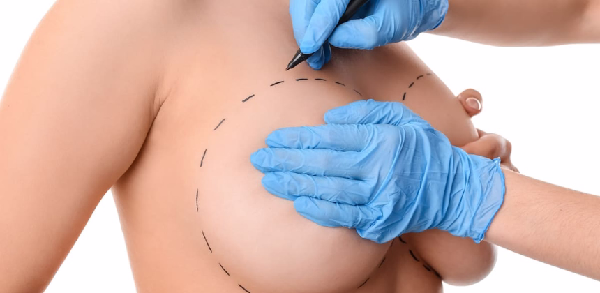 Evaluación preoperatoria mamoplastia: qué evalúa el cirujano plástico