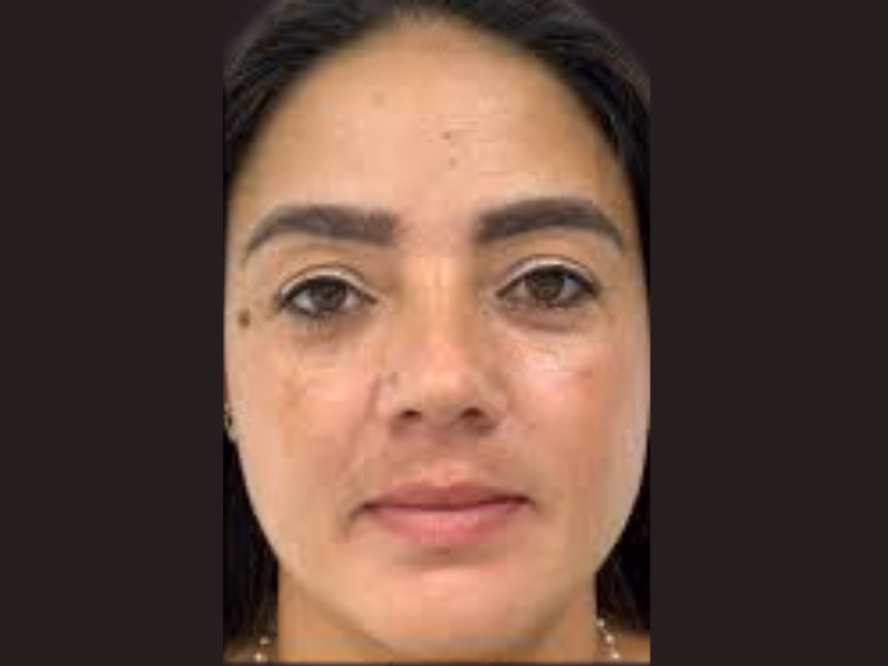 Gestational melasma: typical distribution on cheeks, forehead and upper lip during pregnancy
