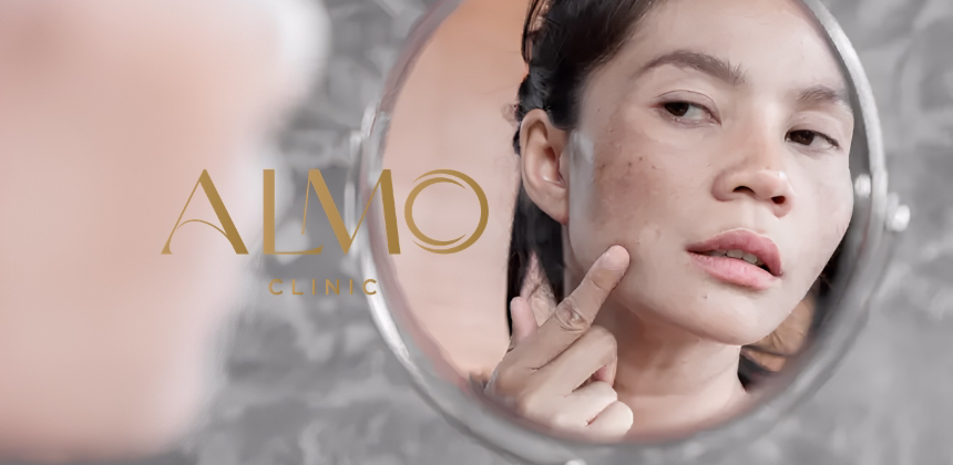 Does Melasma Have a Cure? What Dermatology Says in 2026 | ALMO