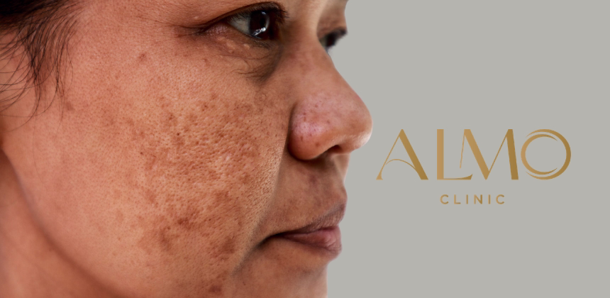 Melasma en el Embarazo: Manchas Hormonales y Cómo Manejarlas | ALMO