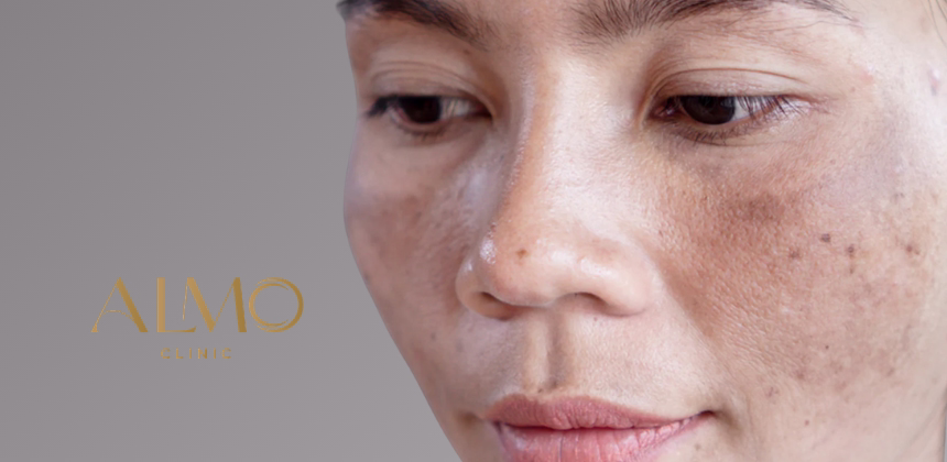 Characteristic distribution of gestational melasma or chloasma during pregnancy Typical areas of pregnancy-induced melasma: cheeks, forehead, upper lip, and chin