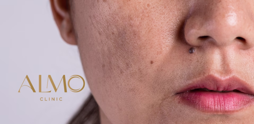 What Is Melasma: Types, Causes and Why It Appears | ALMO Clinic