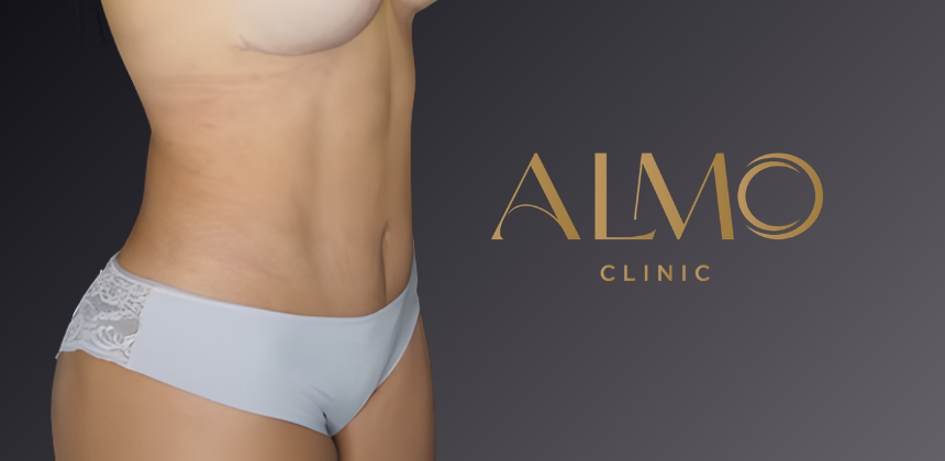 Mommy Makeover vs procedimientos individuales: ¿cuál conviene más?