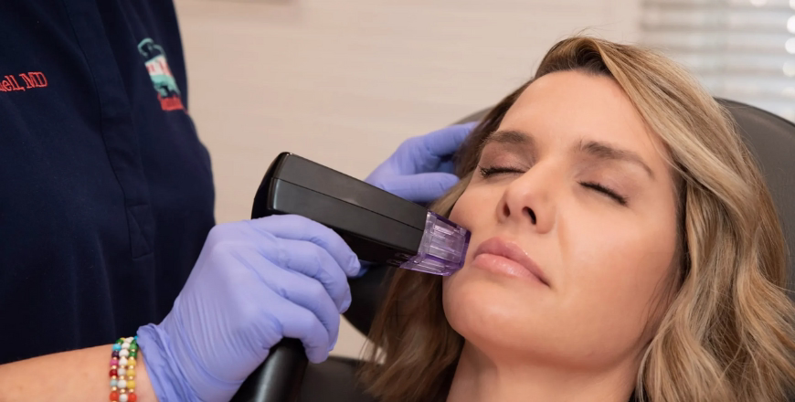 Morpheus8 vs Thermage Bogotá 2025: Complete Comparison | Which to Choose