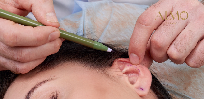 Otoplastia en Niños y Adultos: ¿Cuál es la Edad Ideal para Operarse?