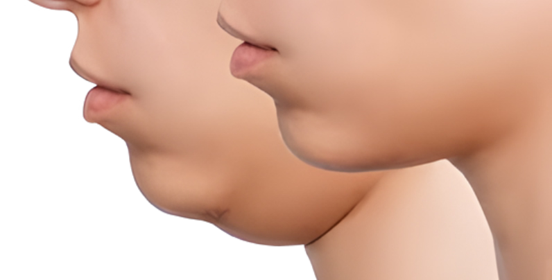 Double chin prevention: exercises and healthy habits Double chin prevention: exercises and healthy habits