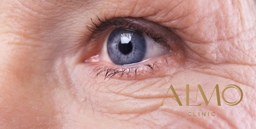 Key areas: crow’s feet, frown lines, forehead