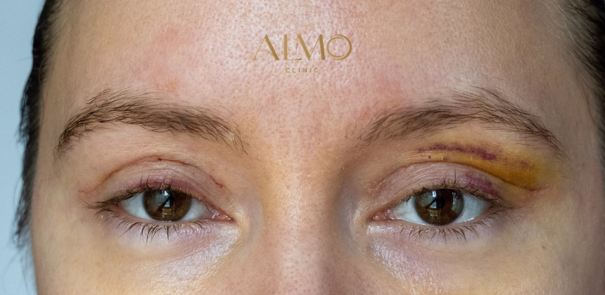 ¿Qué es la Blefaroplastia? Todo lo que Debes Saber