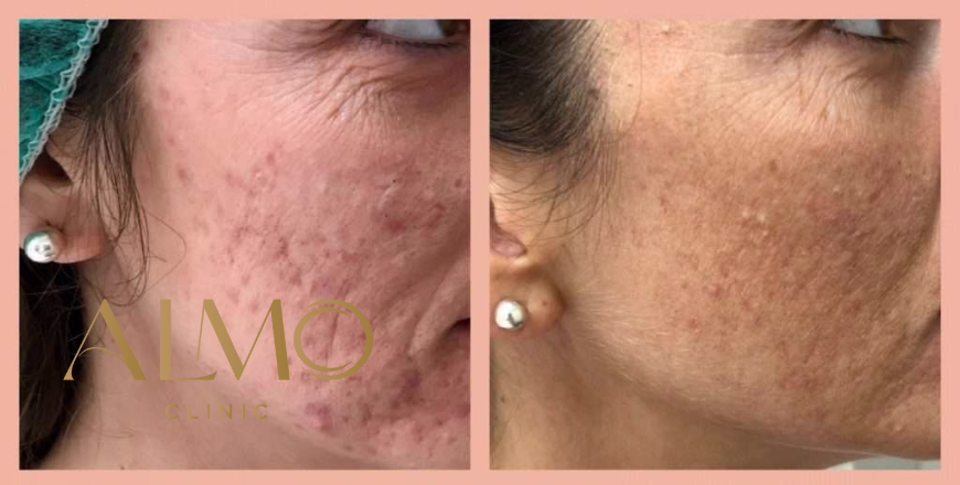 Post-treatment recovery: CO2 laser vs Morpheus8
