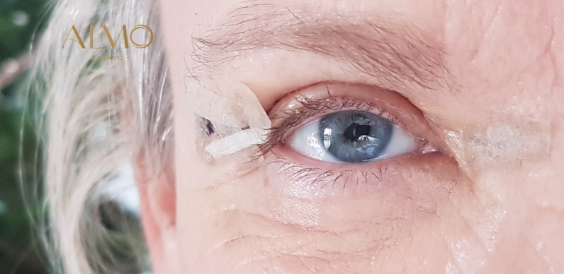 Real blepharoplasty result in Bogotá — recovered eye opening and rested look ALMO Clinic Blepharoplasty result before and after — rejuvenated look eyelid surgery Bogotá ALMO Clinic