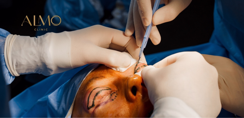 Male blepharoplasty with natural result: rejuvenates without the surgery showing — ALMO Clinic Bogotá Natural result of blepharoplasty in men — rested look without operated appearance Bogotá ALMO Clinic