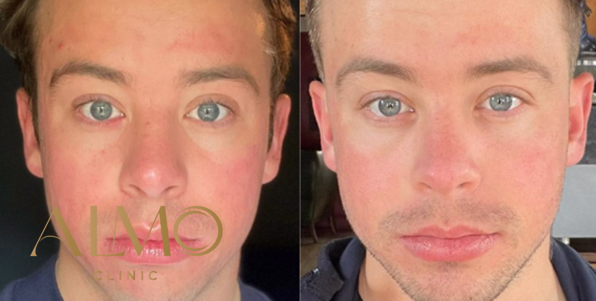 Before and after: CO2 laser results on acne scars