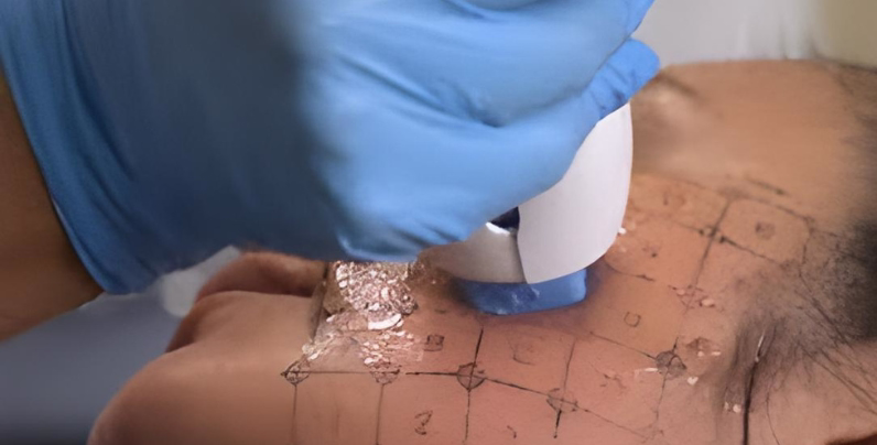 Resultados Morpheus8 vs Thermage: antes y después Bogotá Resultados Morpheus8 vs Thermage: antes y después Bogotá