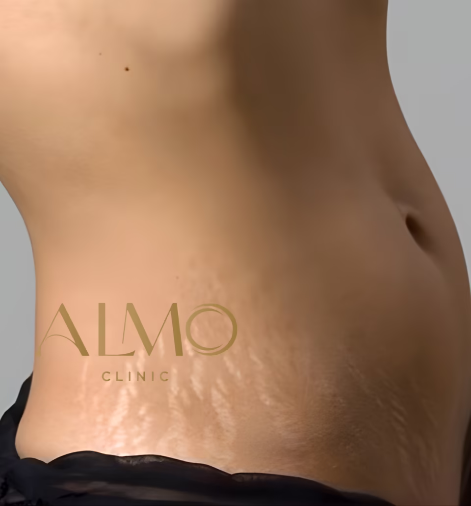 Stretch marks on the stomach: how color and age change treatment Stretch marks on the stomach: thin lines that follow the direction in which the skin stretched