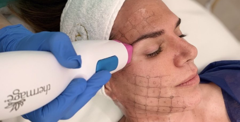 Thermage: radiofrecuencia monopolar tensado facial Thermage: radiofrecuencia monopolar tensado facial