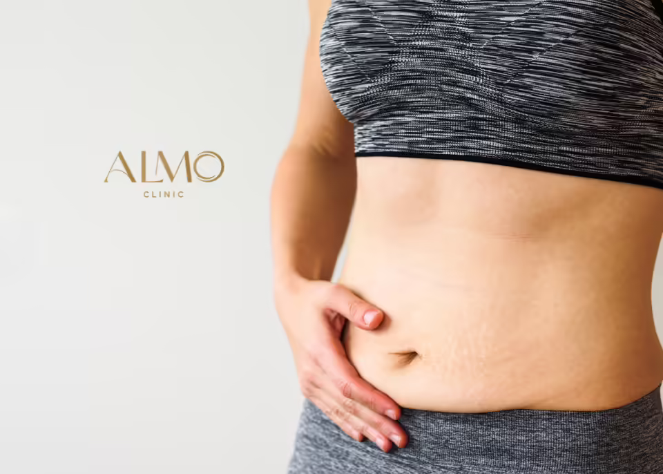 Stretch marks around the belly button and what a tummy tuck can do Woman in a sports top touching her lower belly, with stretch marks around the belly button