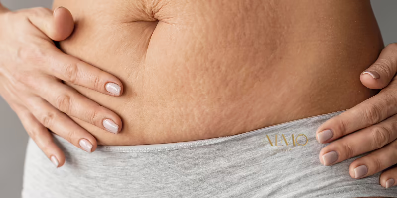 Can a Tummy Tuck Remove Stretch Marks? What Surgeons Say