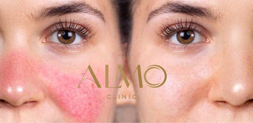 Evidence-Based Rosacea Treatments: Medical Guide 2026 | ALMO Clinic