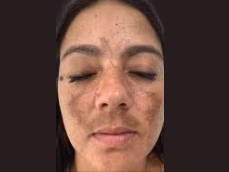 Classification of melasma according to pigmentation depth: epidermal, dermal and mixed Diagram showing classifications of melasma based on pigment depth: epidermal, dermal, and mixed