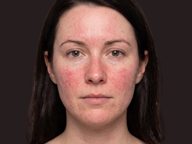 Classification of the 4 rosacea subtypes according to the National Rosacea Society Diagram detailing the 4 subtypes of rosacea: erythematotelangiectatic, papulopustular, phymatous, and ocular