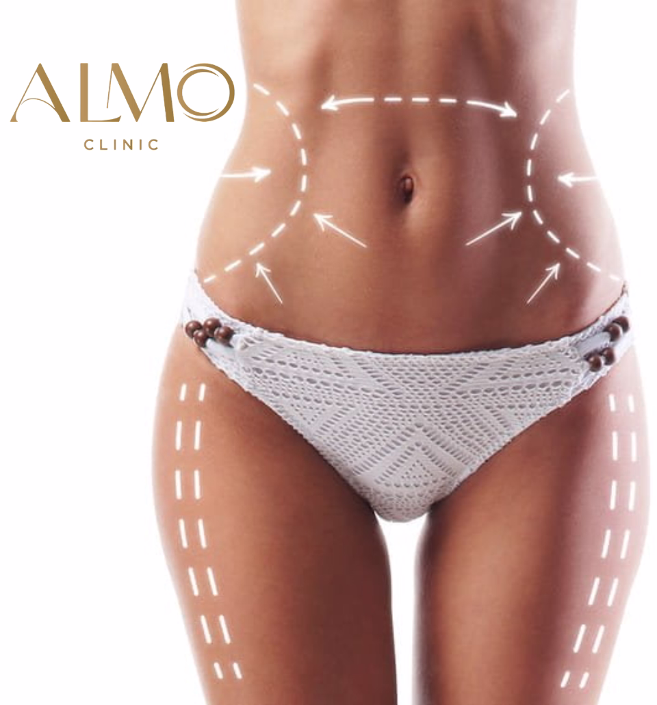 BodyTite abdomen antes y después