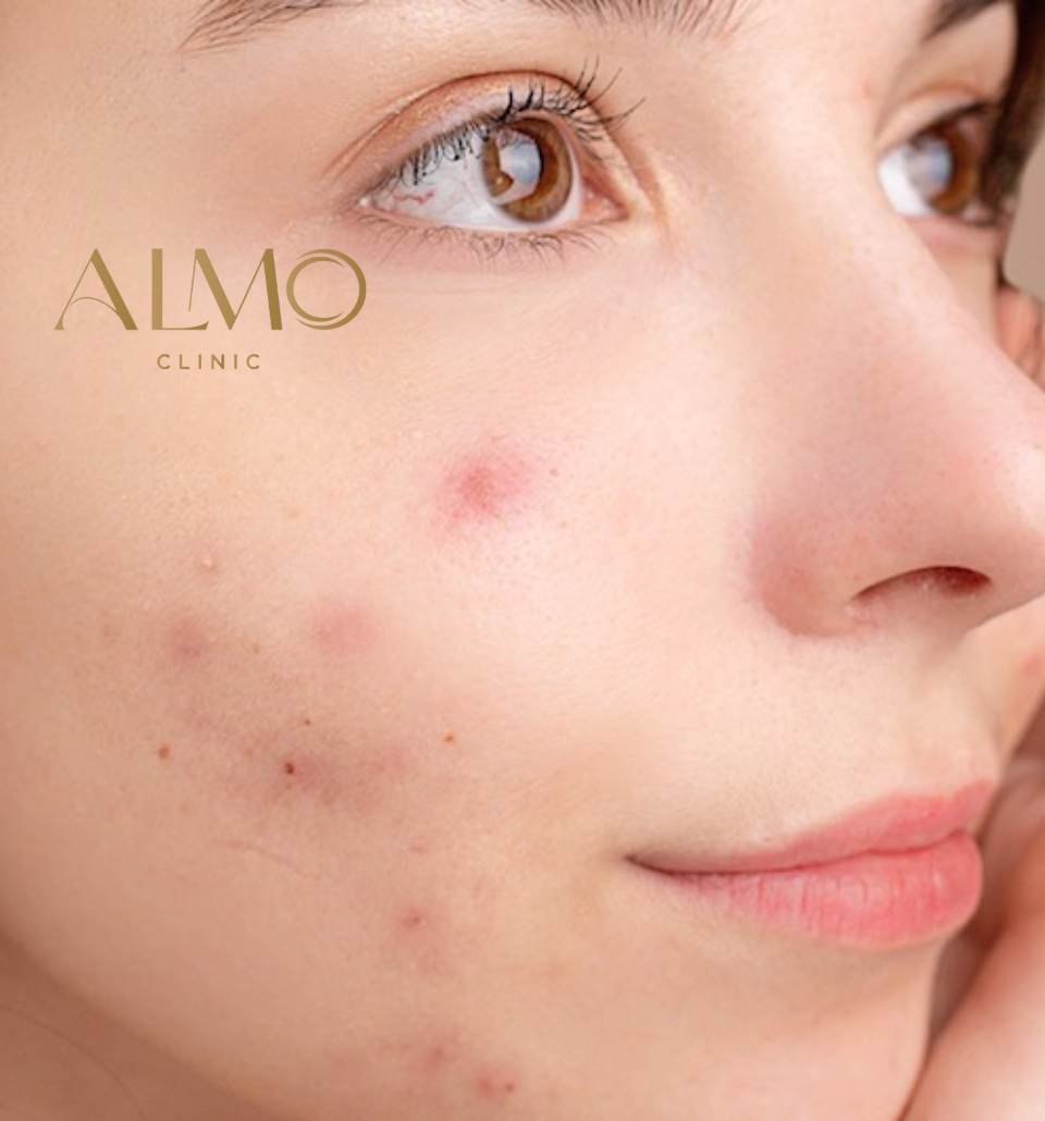 Acne scars classification Types of acne scars