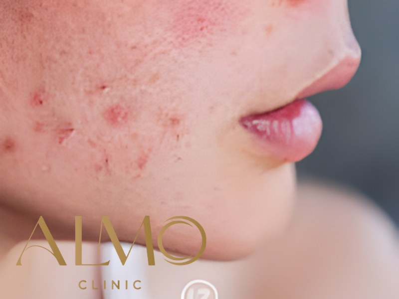 Tratamiento de cicatrices de acné con Morpheus8 en ALMO Clinic Bogotá