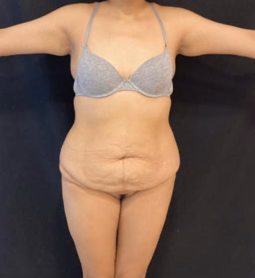 Lipo 360 Bogotá — planificación del contorno circunferencial ALMO Clinic Marcación de zonas para lipo 360 — lipoescultura circunferencial en Bogotá ALMO Clinic